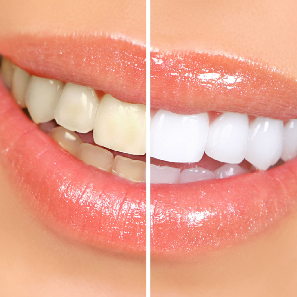 teeth whitening before and after